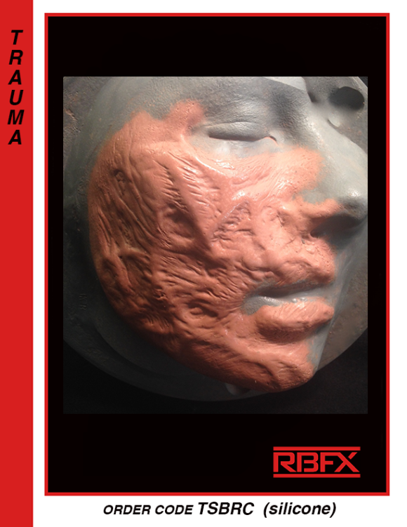 TSBRC - silicone burn/ trauma rt. side of face