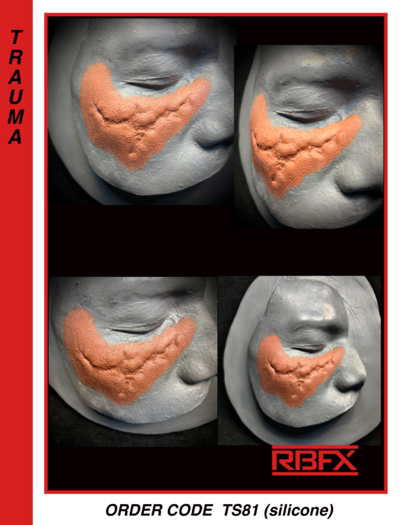TS81 - Silicone right scarred cheekbone